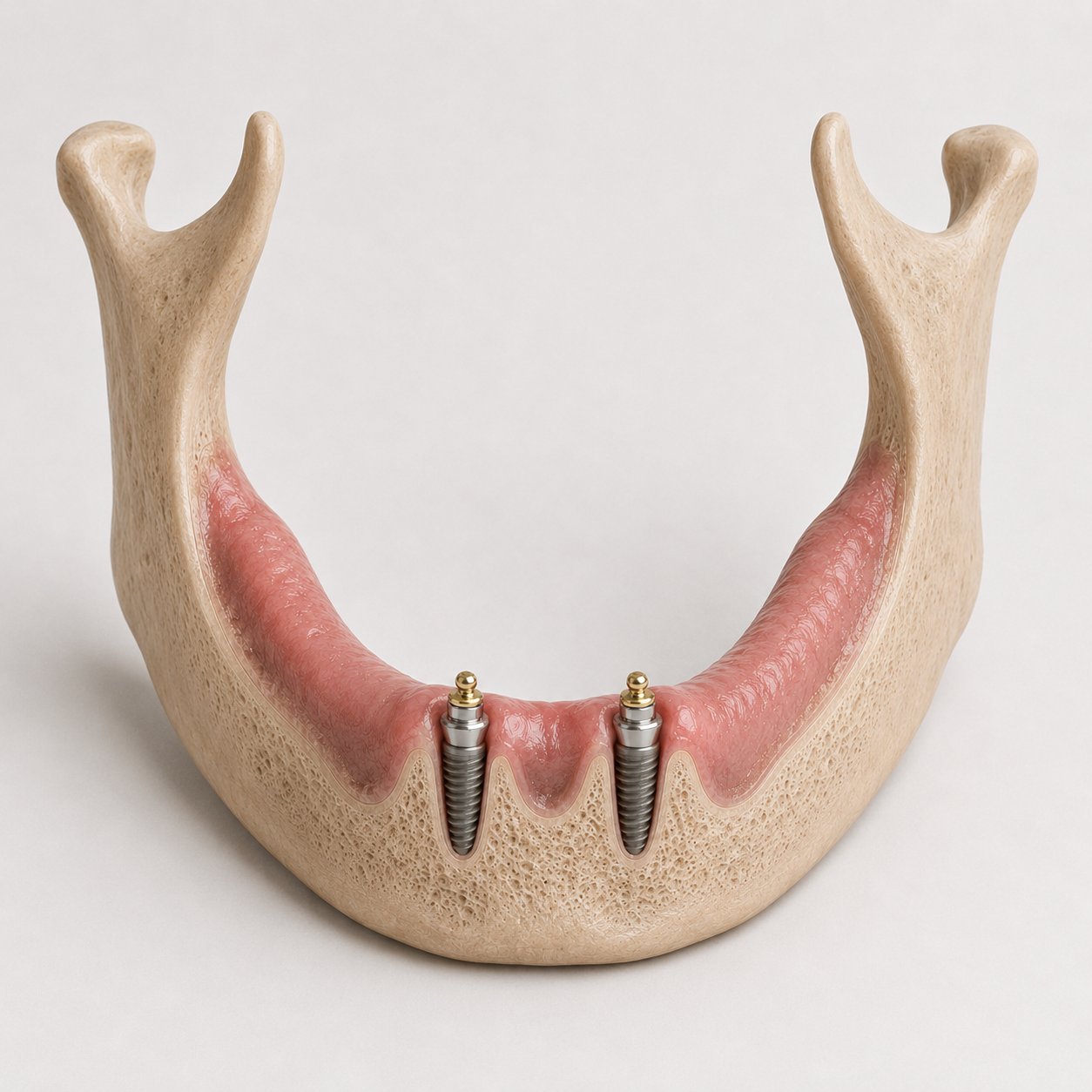 Twee implantaten met drukknoppen in de onderkaak